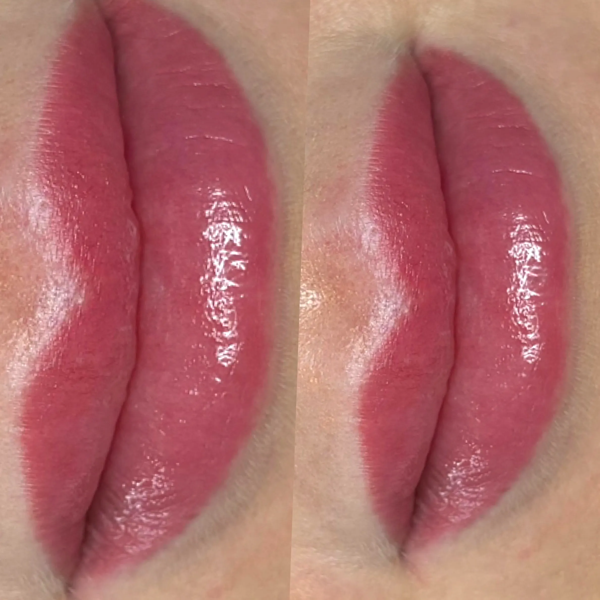 cost of dark lip neutralisation